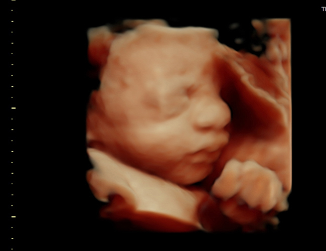 3D ultrasound image at 31 weeks